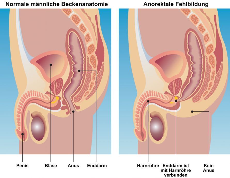 Analatresie (anorektale Fehlbildung) Analatresie (anorektale Fehlbildung)
