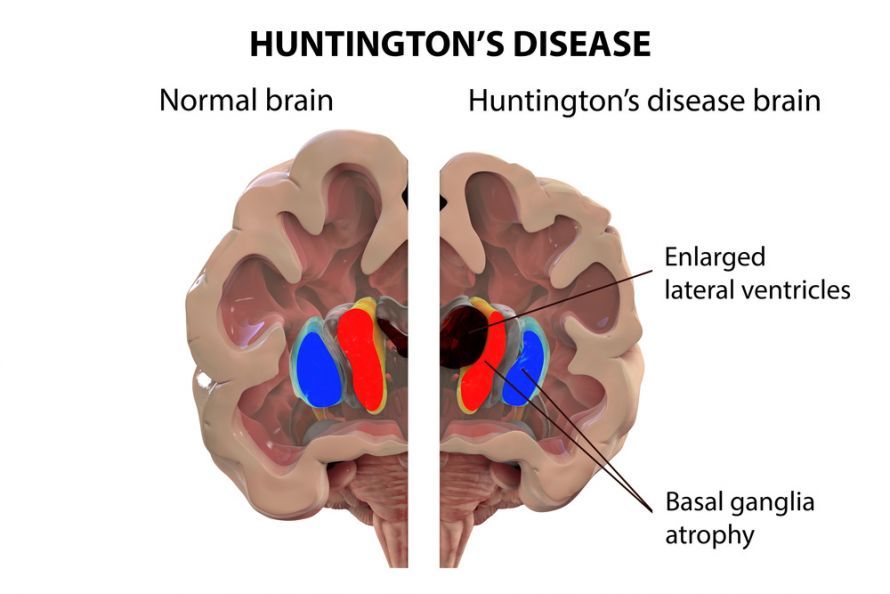 Σκίτσο εγκεφάλου με χορεία του Huntington