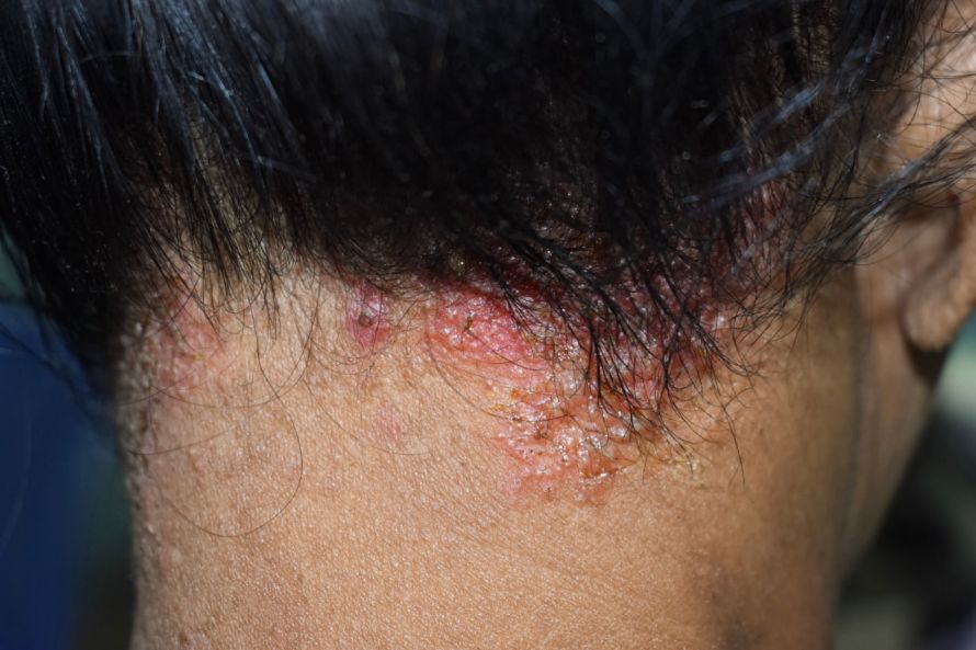 Hautpilz am Kopf Skin Fungus on the Head