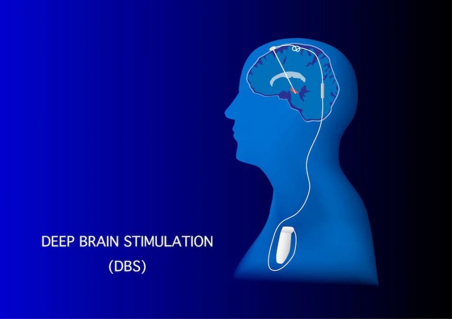 Tiefe Hirnstimulation