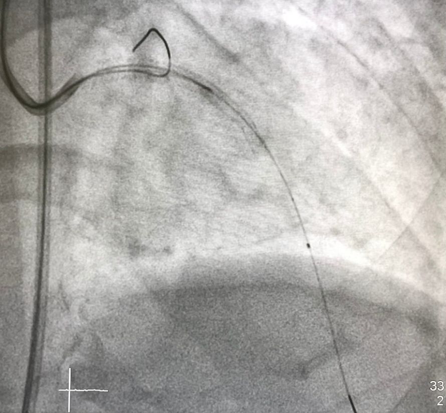 Intravaskulärer Ultraschall Intravaskulärer Ultraschall
