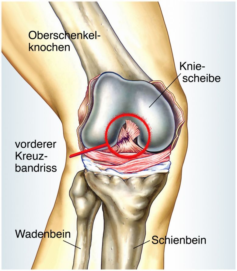 Vorderer Kreuzbandriss Vorderer Kreuzbandriss