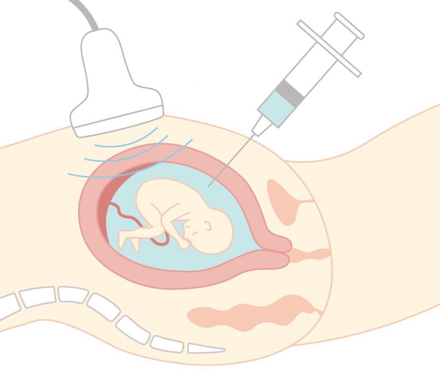 Amniotic Fluid Test