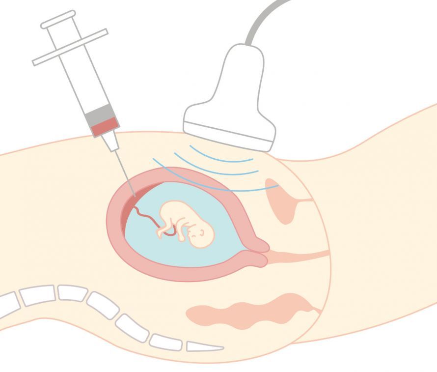 Durchführung einer Chorionzottenbiopsie unter Ultraschallkontrolle Durchführung einer Chorionzottenbiopsie unter Ultraschallkontrolle