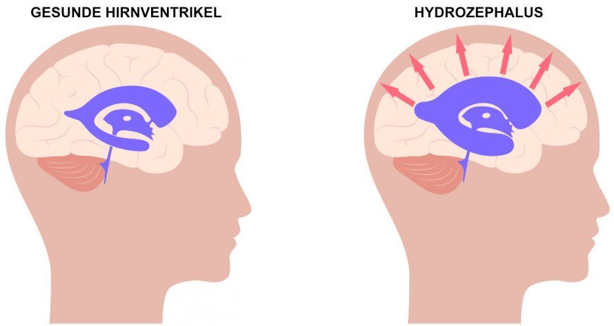 Vergleich normaler Schädel und Hydrozephalus Vergleich normaler Schädel und Hydrozephalus