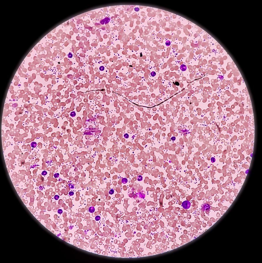 Thrombocythemia