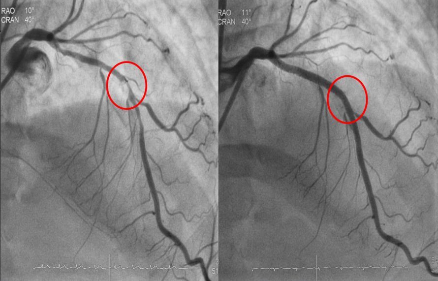Vor und nach einer PTCA mit Stent Πριν και μετά από μια PTCA με στεντ