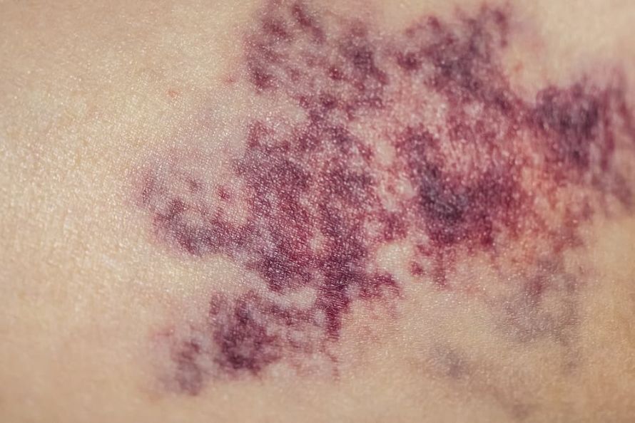 Bluterguss bei Hämophilie