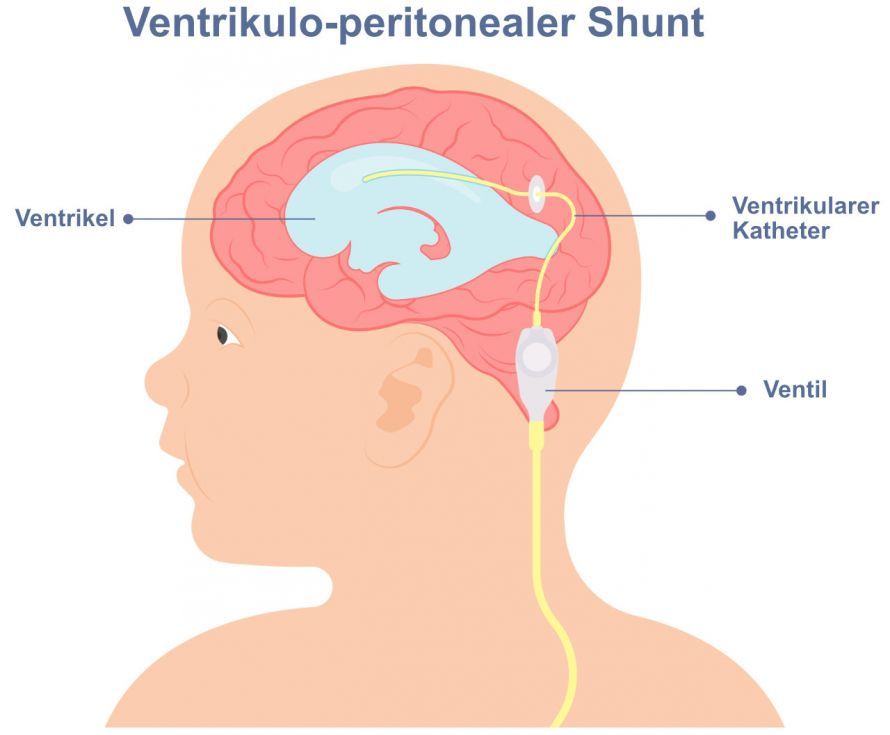 VP-Shunt bei Hydrozephalus VP-Shunt bei Hydrozephalus
