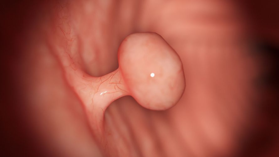 Analpolyp Analpolyp