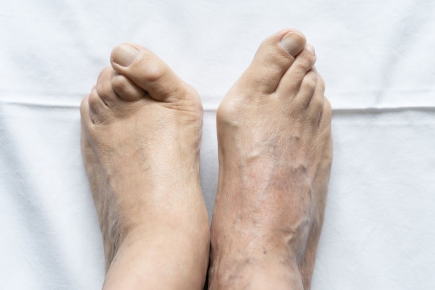Hallux Valgus und Hammerzehen Βαλγός μεγάλος δάκτυλος και σφυροδακτυλία