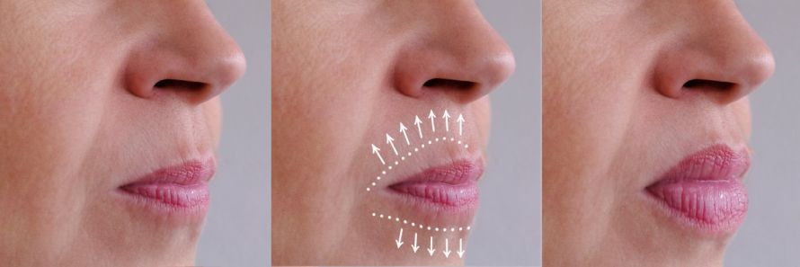 Lippenvergrößerung Lippenvergrößerung