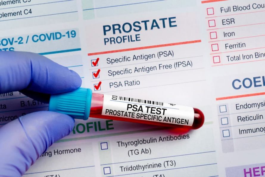 PSA-Test PSA-Test