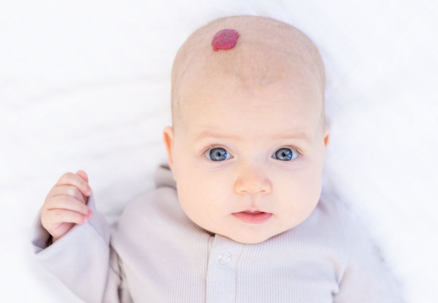 Hemangioma