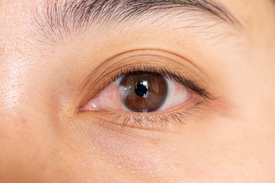 Pterygium conjunctivae Πτερύγιο του επιπεφυκότα