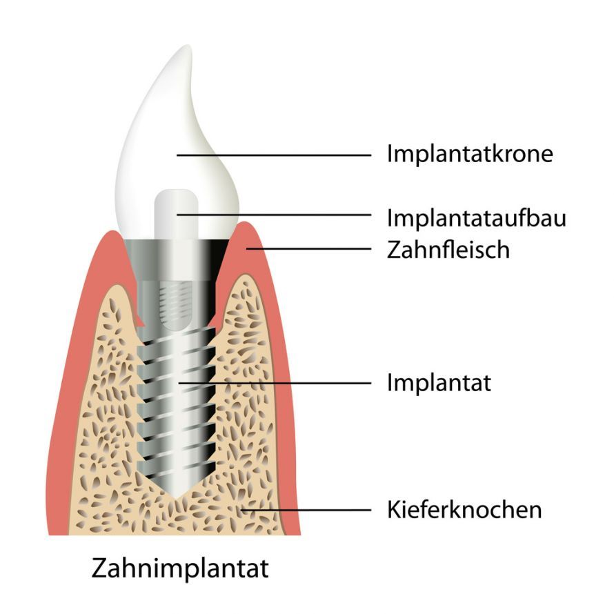 Kieferknochenaufbau