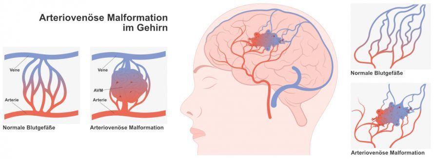 Arteriovenöse Malformation im Gehirn Αρτηριοφλεβική δυσπλασία στον εγκέφαλο