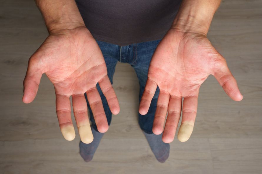 Figner mit Raynaud-Syndrom Fingers with Raynaud's syndrome