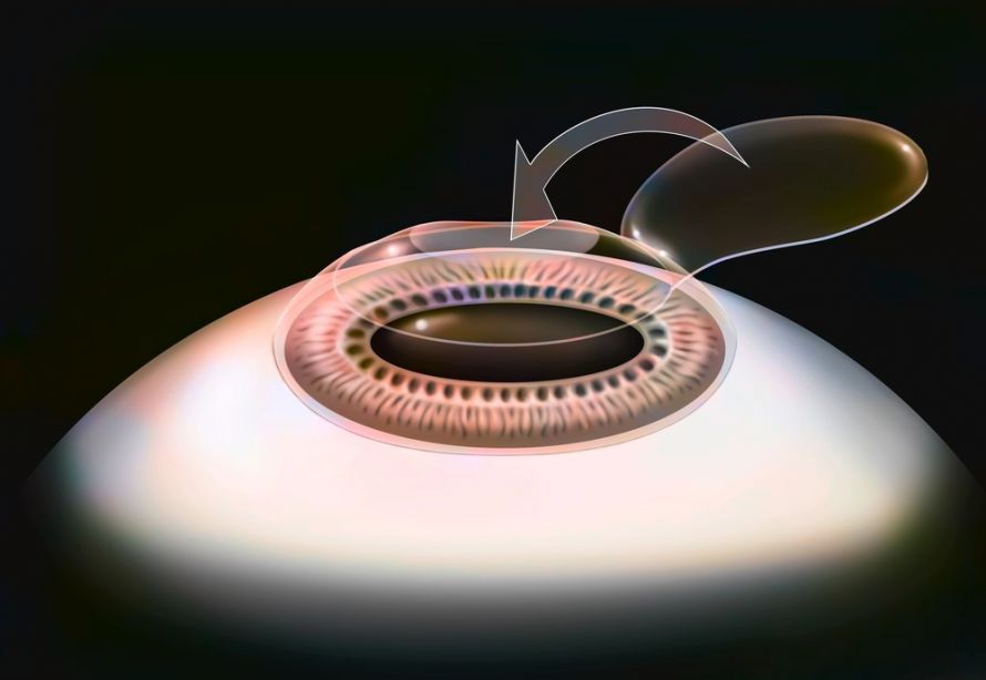Μέθοδος LASIK