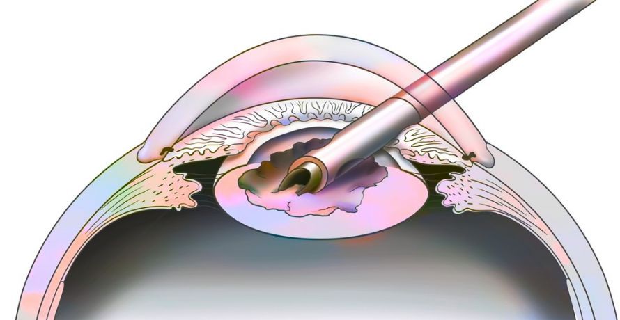 Phakoemulsifikation