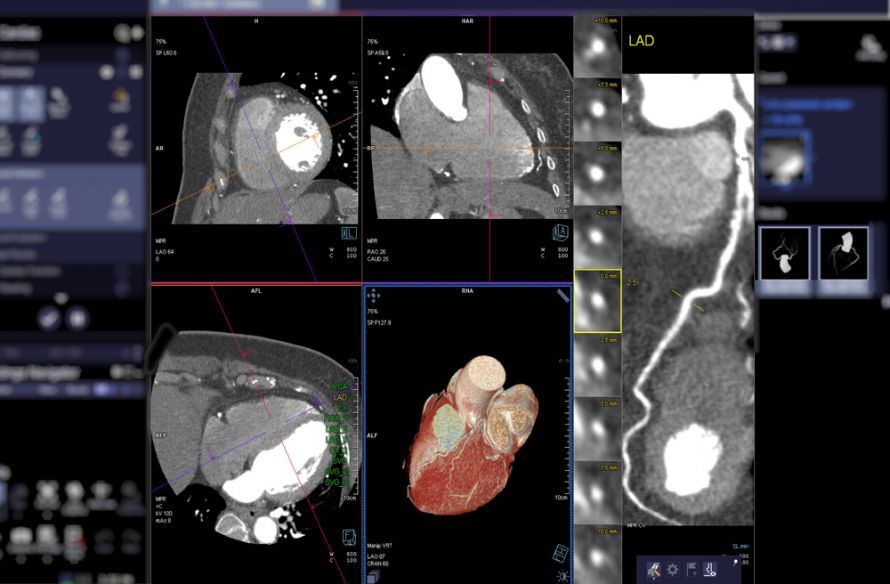 Herz-CT