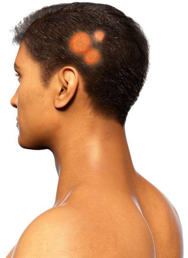 Kopfpilz (Tinea capitis) Ringworm of the scalp (Tinea capitis)