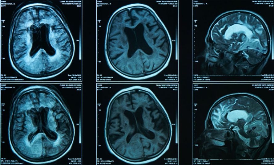 Brain MRI