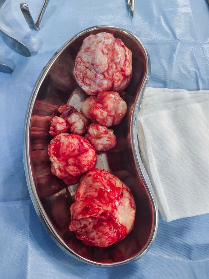 Operativ entfernte Myome Surgically Removed Fibroids