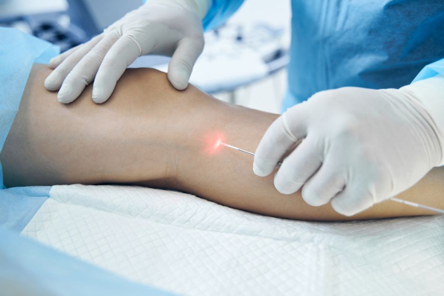 Endovenöse Lasertherapie (EVLT)