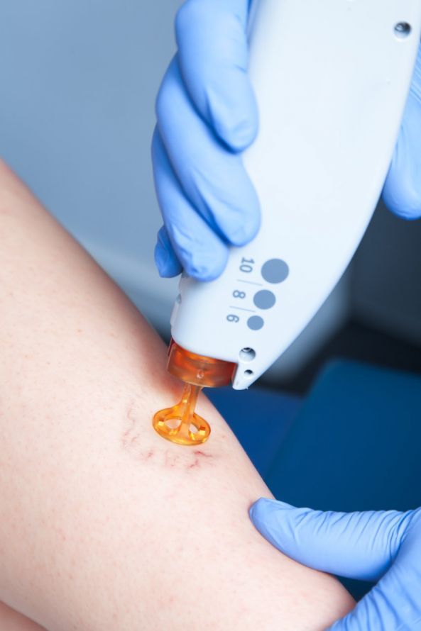 Besenreiser-Behandlung mittels Laser