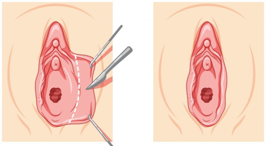 Verkleinerung der inneren Schamlippen Verkleinerung der inneren Schamlippen