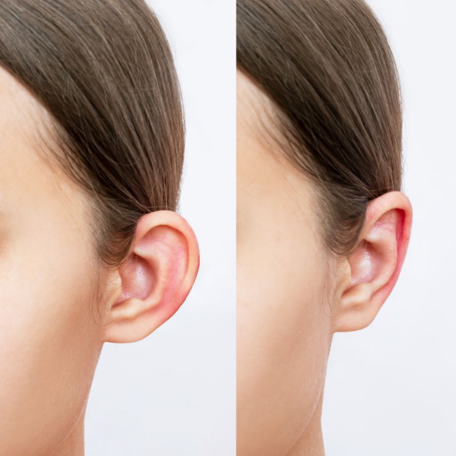 Ear Correction