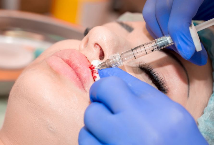 Lip Augmentation with Hyaluronic Acid