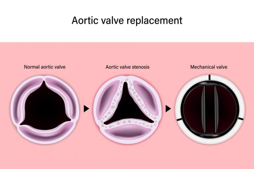 Vergleich gesunde, verkalkte und mechanische Aortenklappe