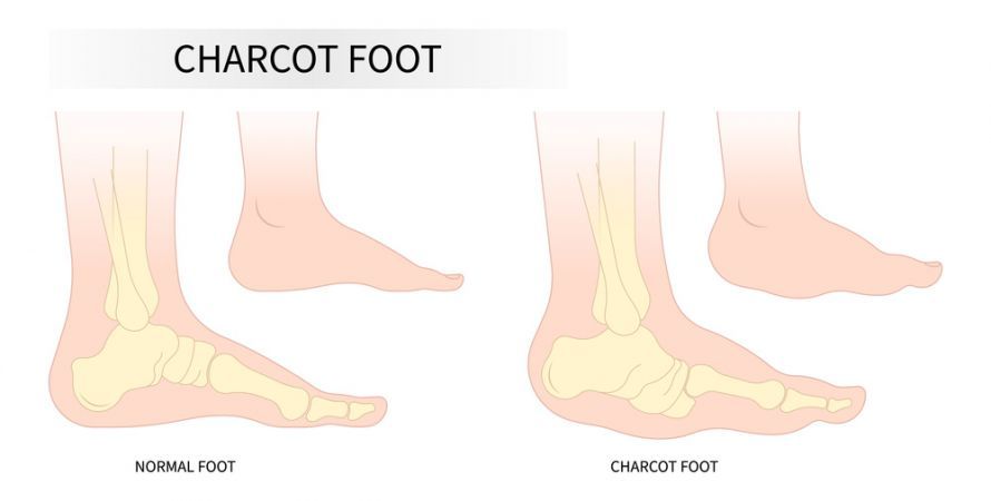 Charcot-Fuß Charcot-Fuß
