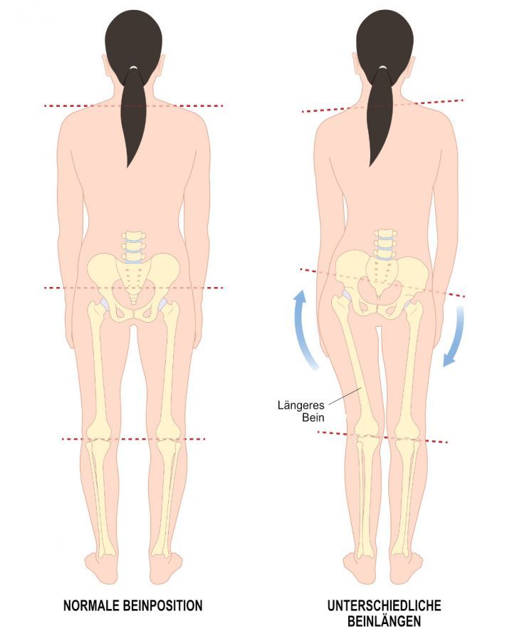 Beinlängendifferenz Διαφορά στο μήκος των ποδιών