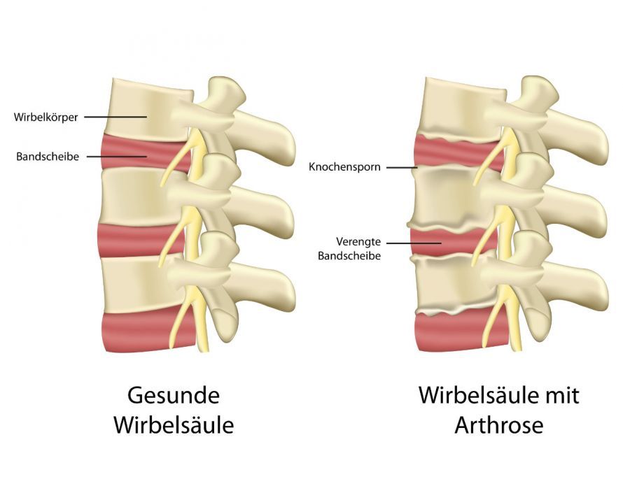 Arthrose der Wirbelgelenke Arthrose der Wirbelgelenke