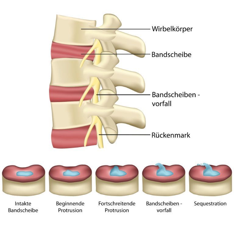 Bandscheibenvorfall Bandscheibenvorfall
