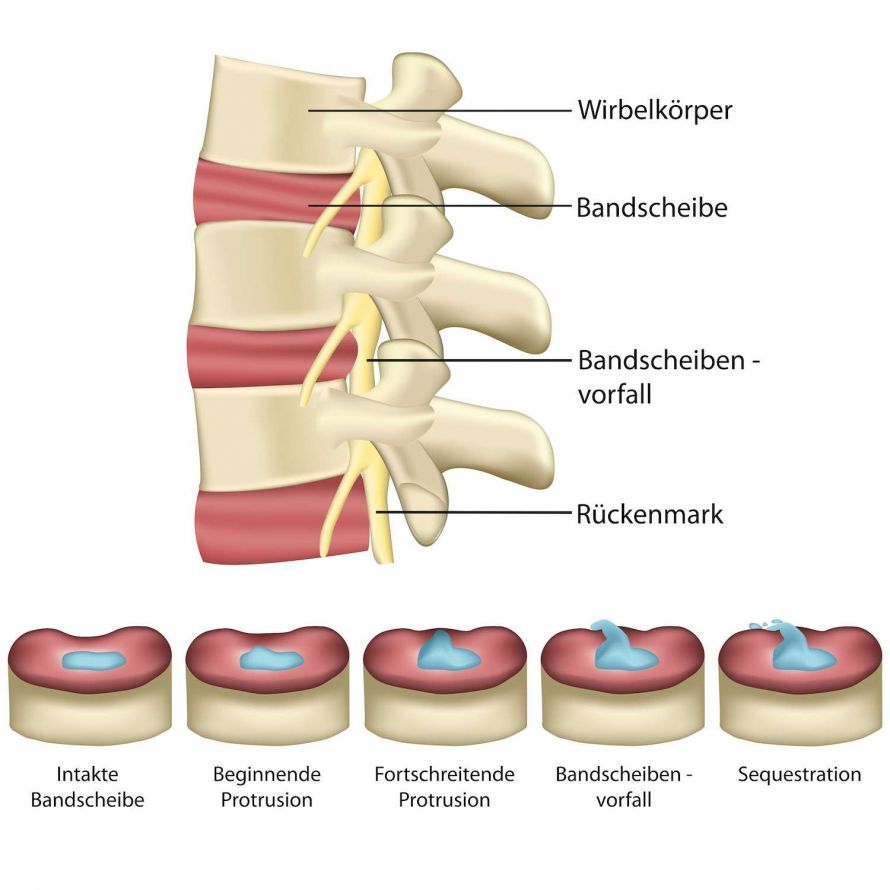Bandscheibenvorfall