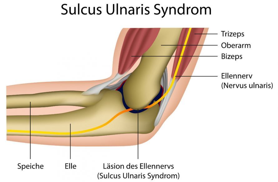 Sulcus Ulnaris-Syndrom am Ellenbogen Σύνδρομο του ωλένιου αυλού στον αγκώνα