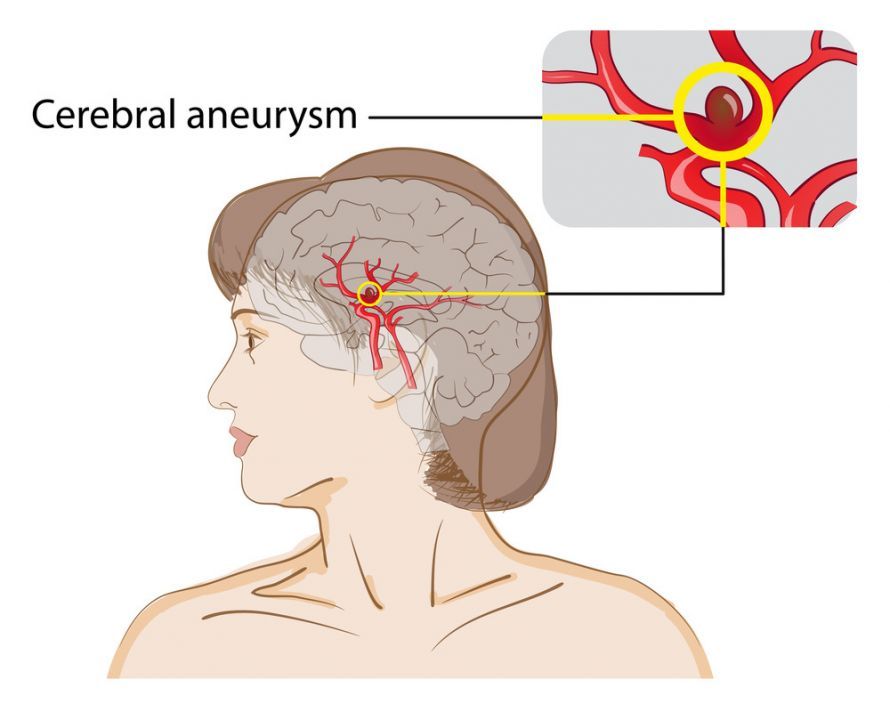 Zerebrales Aneurysma Zerebrales Aneurysma