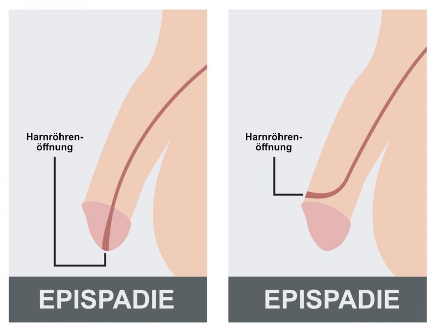 Epispadie Epispadie