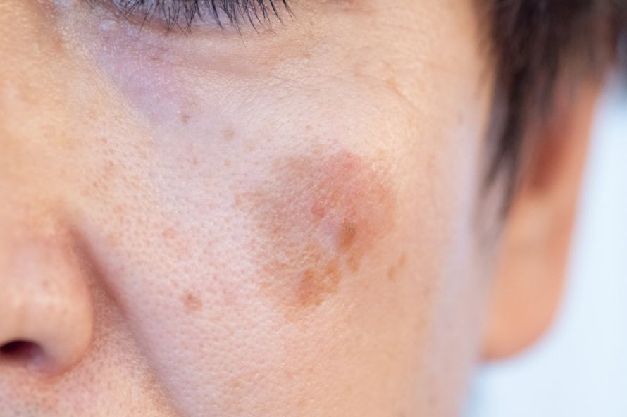 Veränderte Gesichtshaut Changes in Facial Skin