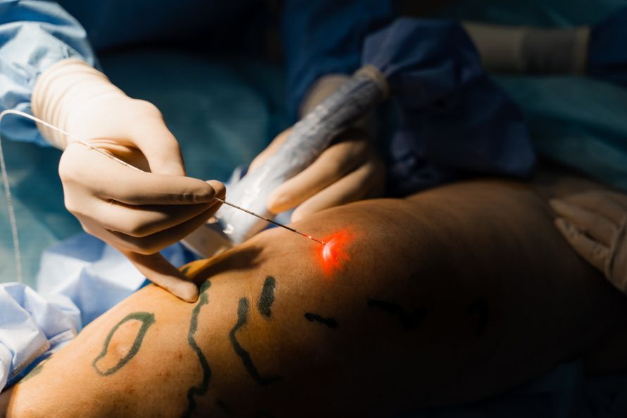 Lasertherapie bei Krampfadern