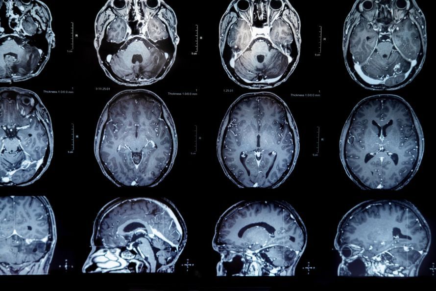 Images from MRI brain scans