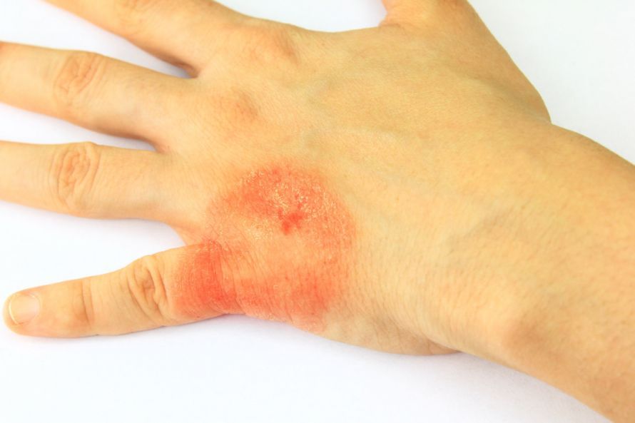 Ausbreitung von Handpilz auf dem Handrücken Spread of a fungal infection on the back of the hand