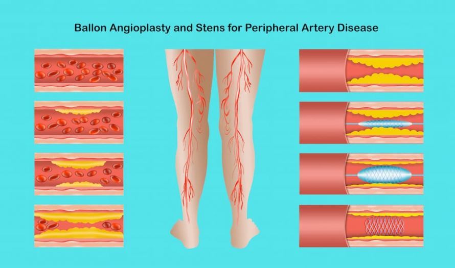Venous stents for the leg