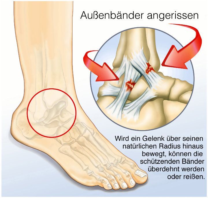 Torn ligament in the foot