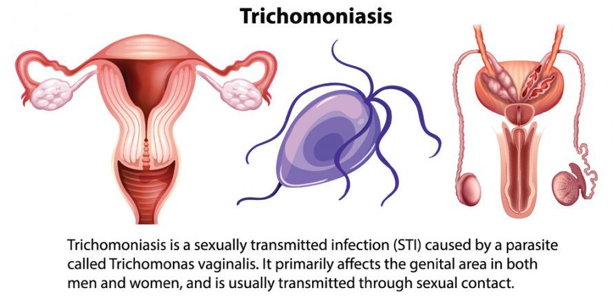 Trichomoniasis Trichomoniasis