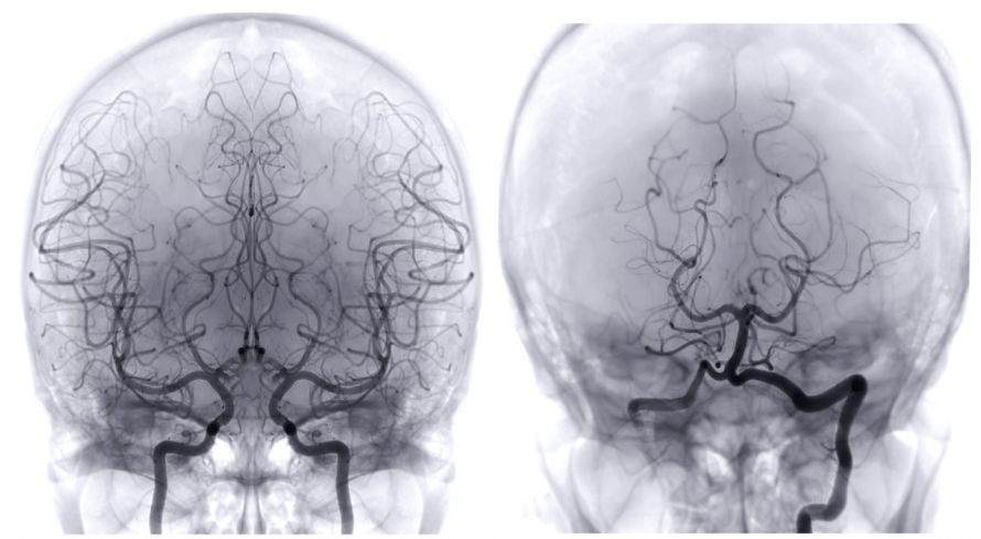 Angiographie der Hirnarterien Angiographie der Hirnarterien